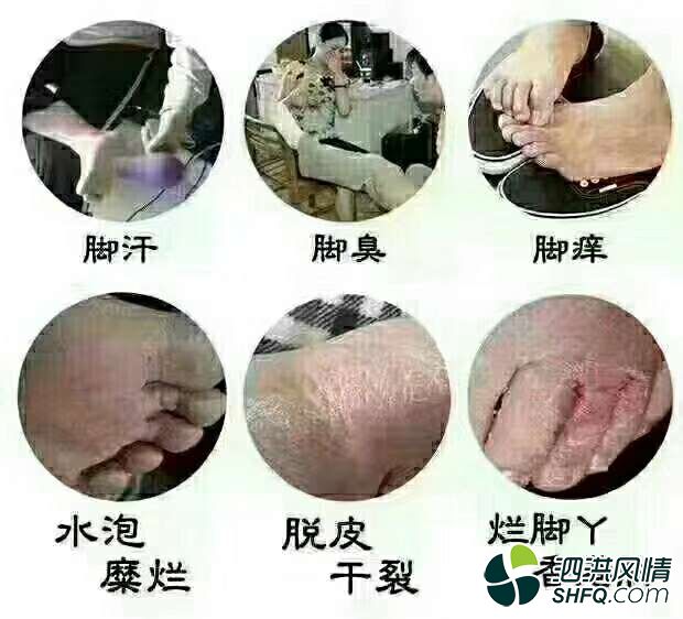 如何治疗脚气和灰指甲